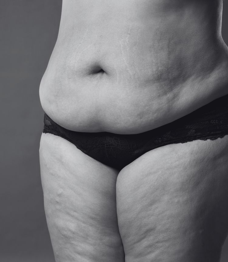 Image comparing mild and severe cellulite grades Bedfordshire