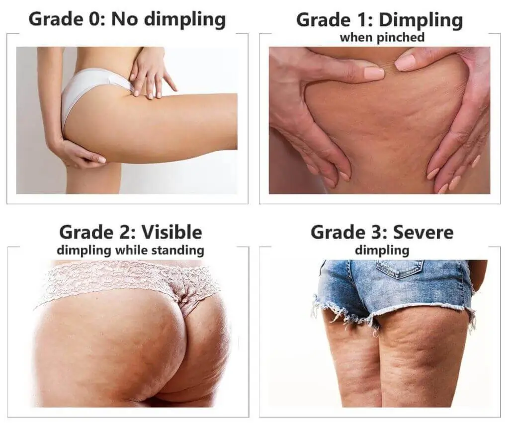 Representation of the stages of cellulite development Bedfordshire